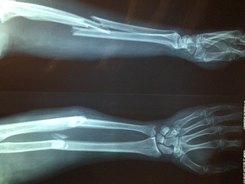 X-ray of a man who suffered a horrific crush injury to his - MEDizzy
