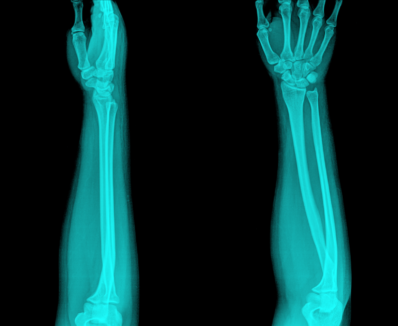 Arm x-ray , two position
